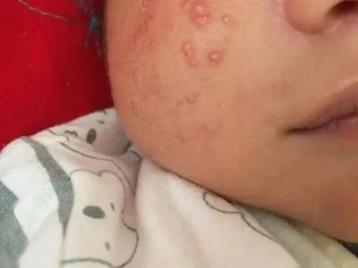青春期前痤瘡面部長小膿包圖 青春期前痤瘡面部長小膿包圖