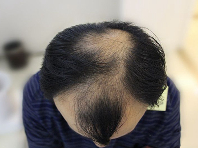 雄激素性脫髮頭髮脫落露出頭皮圖 雄激素性脫髮頭髮脫落露出頭皮圖