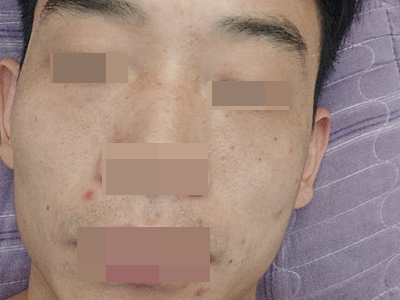 黑頭臉上毛孔粗大有小黑點圖 黑頭臉上毛孔粗大有小黑點圖