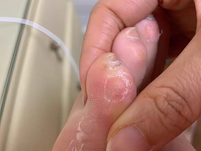 胼胝小腳趾背面腫硬掉皮圖 胼胝小腳趾背面腫硬掉皮圖