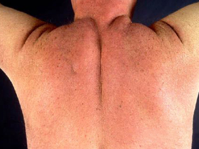 硬腫病背部肌肉又腫又硬圖
