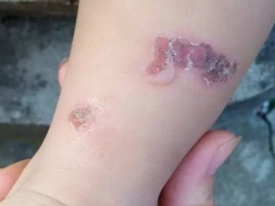 新生兒膿皰瘡小腿結痂圖 新生兒膿皰瘡小腿結痂圖