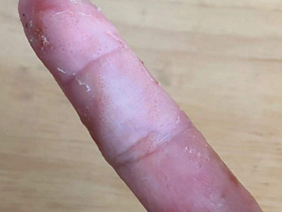 手部濕疹手指大片脫皮圖