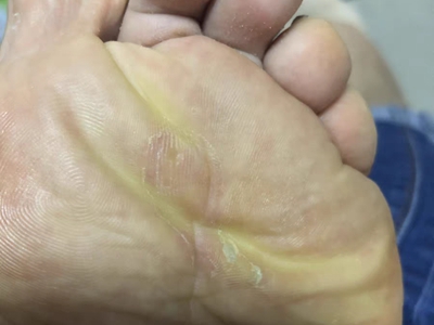 胼胝腳底有幾條黃色硬塊圖 胼胝腳底有幾條黃色硬塊圖