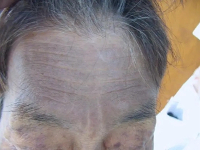 瑞爾黑變病額頭皮膚發灰圖