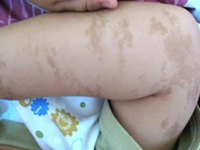 咖啡斑大腿很多棕色斑塊圖 咖啡斑大腿很多棕色斑塊圖