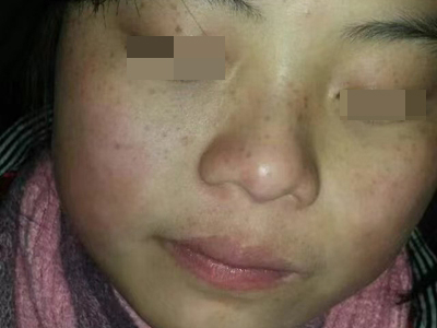 雀斑面部出現好多褐色斑點圖