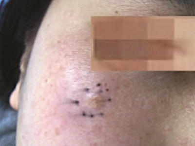 硬化性汗腺導管癌面部有大結節圖 硬化性汗腺導管癌面部有大結節圖