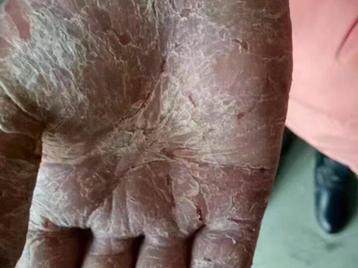 手部濕疹手掌都是裂紋圖 手部濕疹手掌都是裂紋圖