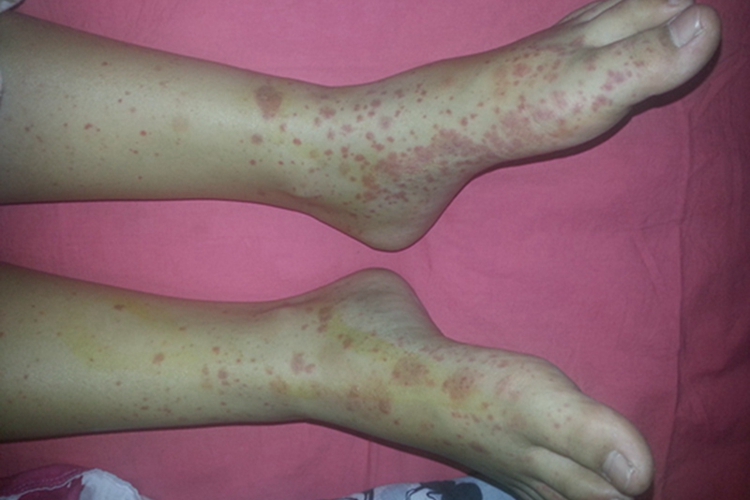 小兒過敏性紫癜腳踝內側有紅斑圖 小兒過敏性紫癜腳踝內側有紅斑圖