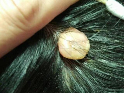 皮膚纖維瘤頭皮上長個白色肉粒圖