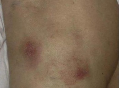 人工性脂膜炎大腿有紅色斑塊圖