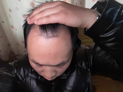 雄激素性脫髮頭上髮際線很高圖 雄激素性脫髮頭上髮際線很高圖
