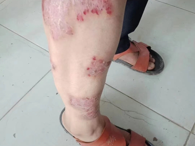 尋常型銀屑病小腿有紅色斑塊圖 尋常型銀屑病小腿有紅色斑塊圖