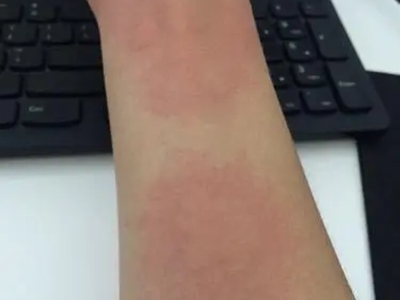 海鮮過敏胳膊上有大面積紅斑圖 海鮮過敏胳膊上有大面積紅斑圖