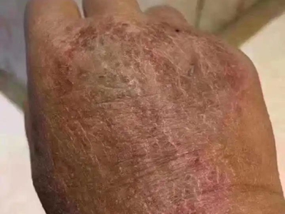 手部濕疹手背有紅褐色結痂圖 手部濕疹手背有紅褐色結痂圖