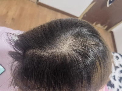 雄激素性脫髮頭頂發縫寬露頭皮圖