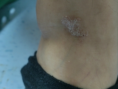 尋常型銀屑病小腿有不規則脫屑圖