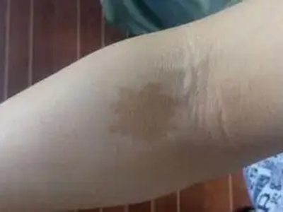 咖啡斑胳膊上有不規則的淺棕色斑圖 咖啡斑胳膊上有不規則的淺棕色斑圖