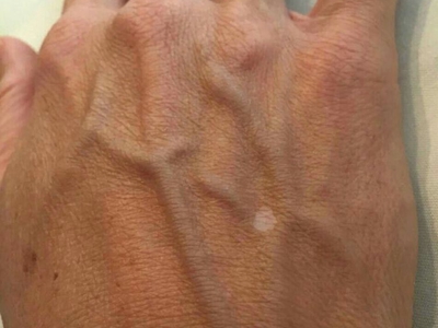 特發性滴狀色素減少症手背有白斑圖