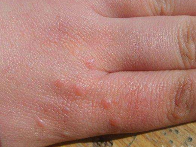 手足膠原斑手指有圓形疙瘩圖 手足膠原斑手指有圓形疙瘩圖