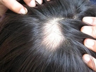 雄激素性脫髮頭頂一塊地方掉頭髮圖