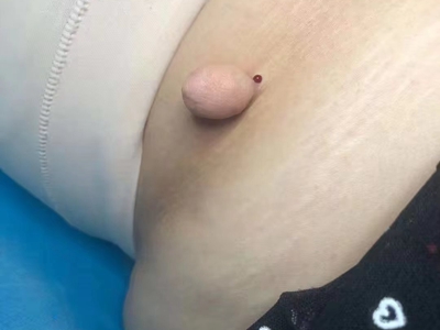 皮膚纖維瘤腹部長個光滑的肉疙瘩圖 皮膚纖維瘤腹部長個光滑的肉疙瘩圖