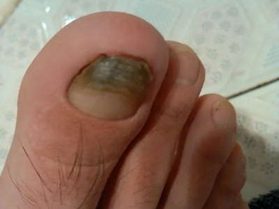 嵌甲腳趾甲邊緣腫脹趾甲前端變黑圖
