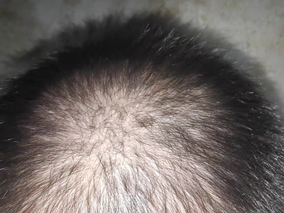 雄激素性脫髮頭髮減少露出頭皮圖 雄激素性脫髮頭髮減少露出頭皮圖