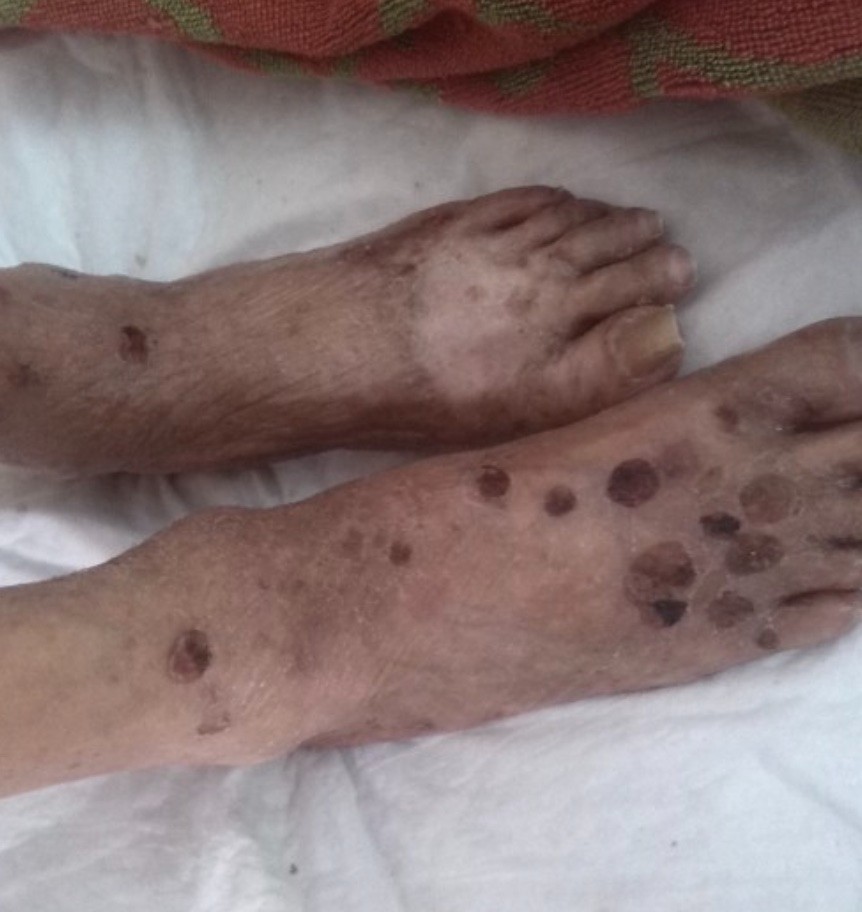 愛滋病皮膚腫瘤腳背上起黑色斑塊圖 愛滋病皮膚腫瘤腳背上起黑色斑塊圖
