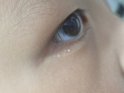 原發性粟丘疹眼角出現白色小疹子圖
