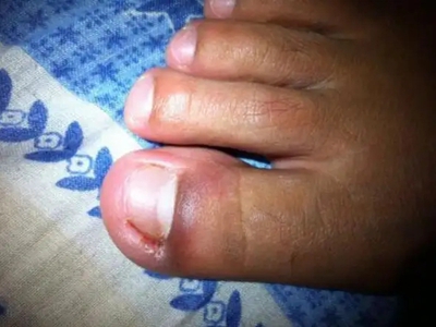 嵌甲大拇腳趾外側甲溝腫脹滲血圖