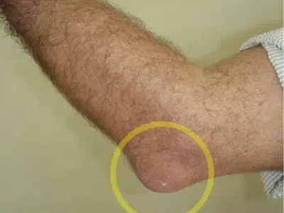 原藻性鷹嘴滑囊炎胳膊肘腫大包圖 原藻性鷹嘴滑囊炎胳膊肘腫大包圖