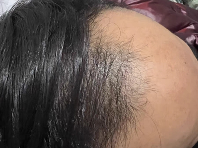 雄激素性脫髮頭髮脫落額頭變高圖 雄激素性脫髮頭髮脫落額頭變高圖