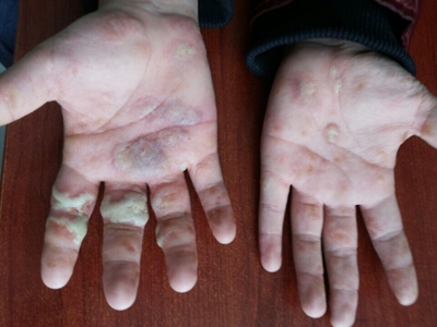 皰疹樣膿皰病手掌有白色膿包圖 皰疹樣膿皰病手掌有白色膿包圖