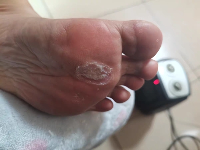 胼胝腳底有個硬塊掉了一部分圖