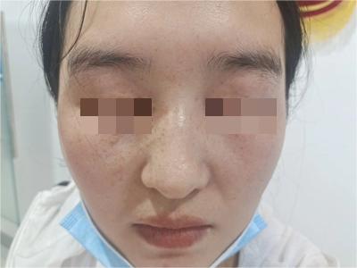 雀斑眼睛周邊有密集的褐色斑點圖 雀斑眼睛周邊有密集的褐色斑點圖