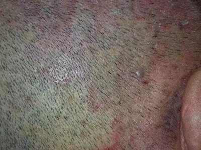 尋常型銀屑病頭皮有大片紅斑圖