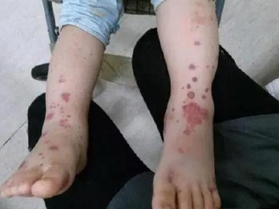 小兒過敏性紫癜腳腕紫紅色斑片圖