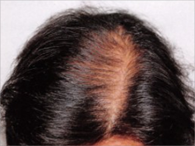 女性型脫髮頭頂毛髮稀疏發縫寬圖 女性型脫髮頭頂毛髮稀疏發縫寬圖