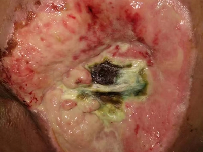 潰瘍期壓瘡臀部潰瘍化膿圖 潰瘍期壓瘡臀部潰瘍化膿圖