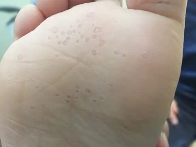 窩狀角質松解症腳底有多個小坑圖