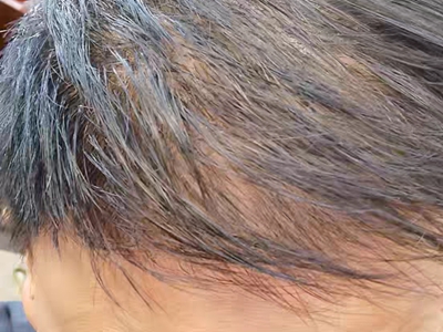 雄激素性脫髮頭髮變少有點露頭皮圖 雄激素性脫髮頭髮變少有點露頭皮圖