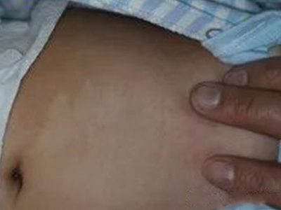 脫色素性痣腹部有塊白色斑圖 脫色素性痣腹部有塊白色斑圖