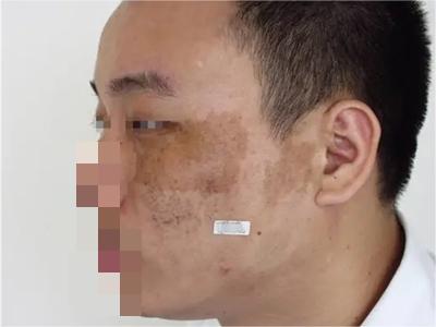 咖啡斑面部有不規則咖啡色斑圖 咖啡斑面部有不規則咖啡色斑圖