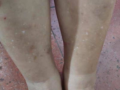 特發性滴狀色素減少症小腿有白點圖