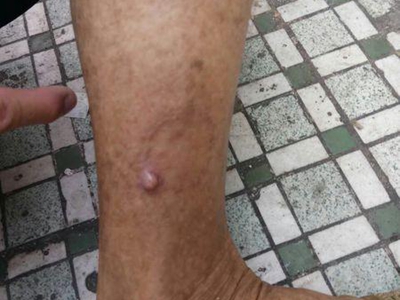 小汗腺汗孔瘤小腿上有粉紅色的疙瘩圖 小汗腺汗孔瘤小腿上有粉紅色的疙瘩圖