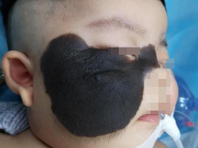 獸皮痣面部有大黑斑還長毛圖