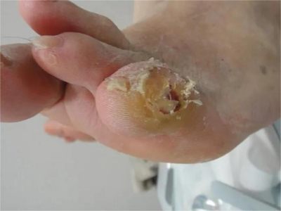 胼胝小腳趾處有黃色繭子破潰圖