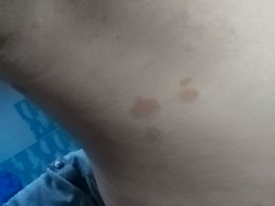 網狀肢端色素沉著膕窩有褐色斑點圖 網狀肢端色素沉著膕窩有褐色斑點圖
